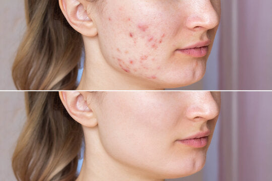 BNB Acne Control Kit