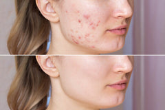 BNB Acne Control Kit