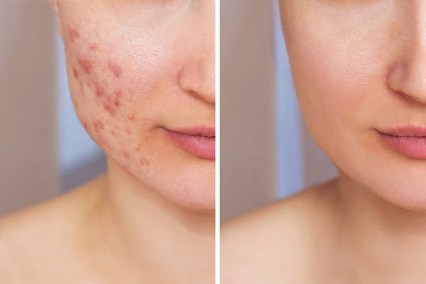BNB Acne Control Kit
