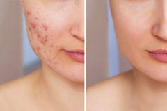 BNB Acne Control Kit