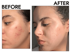 BNB Acne Control Kit